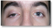 Eyelid ptosis 3