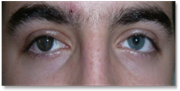 Eyelid ptosis 4