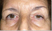 Eyelid ptosis 5
