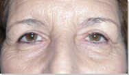 Eyelid ptosis 7
