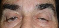 Eyelid ptosis 9