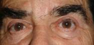 Eyelid ptosis 10
