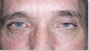 Eyelid ptosis 12