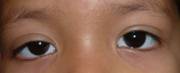 Eyelid ptosis 15