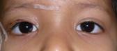 Eyelid ptosis 16