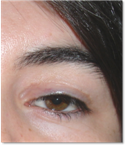 Eyelid ptosis 19