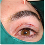 Eyelid ptosis 20