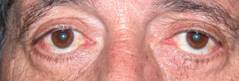 Eyelid retraction 2