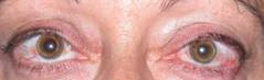 Eyelid retraction 3