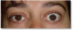 Eyelid retraction 4