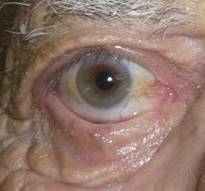 Eyelid retraction 11