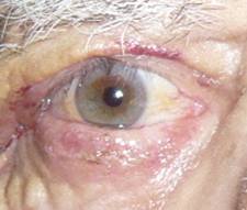 Eyelid retraction 12