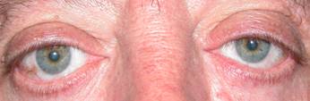 Eyelid retraction 13