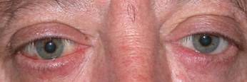 Eyelid retraction 14