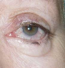 Eyelid retraction 15