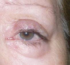 Eyelid retraction 16