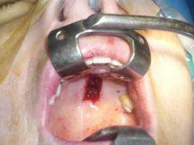 Eyelid retraction 17