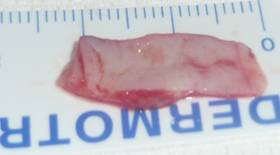 Eyelid retraction 18