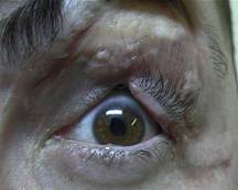 Eyelid trauma 3