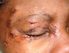 Eyelid trauma 4