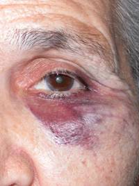 Eyelid trauma 5