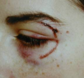 Eyelid trauma 8