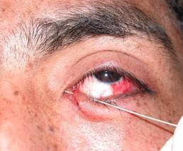 Eyelid trauma 10