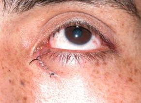 Eyelid trauma 11