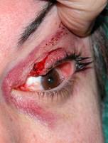 Eyelid trauma 12