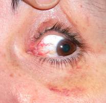 Eyelid trauma 13