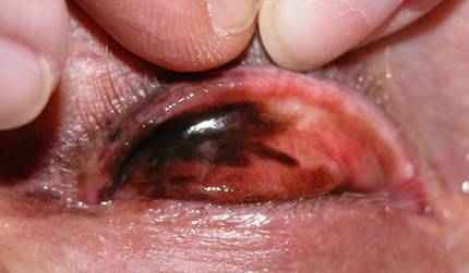 Conjunctival tumors 1