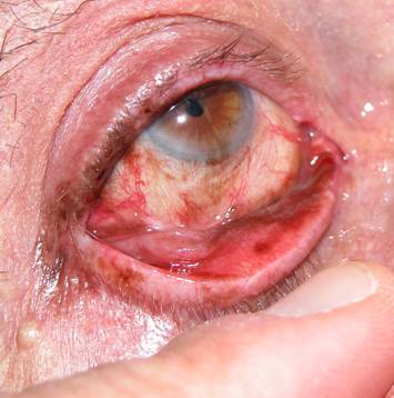 Conjunctival tumors 2