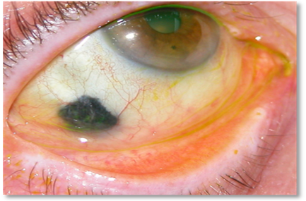 Conjunctival tumors 3