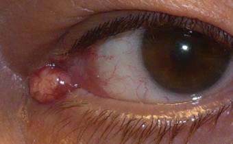 Conjunctival tumors 5