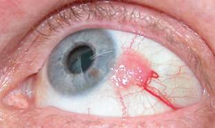Conjunctival tumors 7