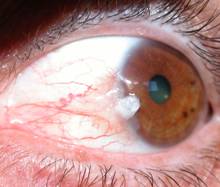 Conjunctival tumors 8