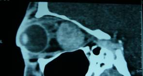Orbital tumours 1