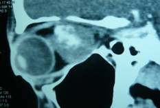 Orbital tumours 2