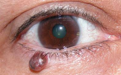 Eyelid Tumours 2