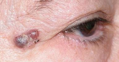 Eyelid Tumours 4