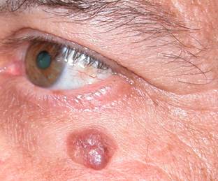 Eyelid Tumours 5
