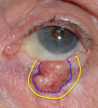 Eyelid Tumours 6