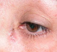 Eyelid Tumours 7