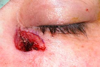 Eyelid Tumours 8