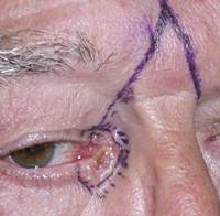 Eyelid Tumours 11