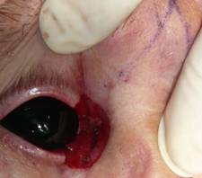 Eyelid Tumours 12