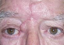 Eyelid Tumours 16