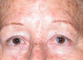 Eyelid Tumours 18
