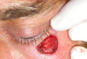 Eyelid Tumours 20