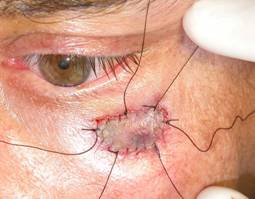 Eyelid Tumours 21
